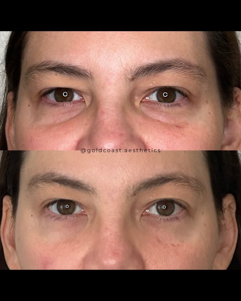 Before and after comparison showing reduced under-eye bags and puffiness, credited to Gold Coast Aesthetics