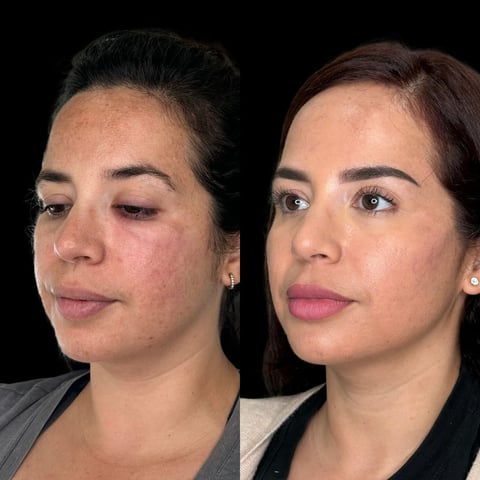 Before and after skin treatment comparison showing improved complexion and reduced blemishes on womans face