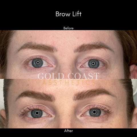 Before and after brow lift comparison showing lifted and fuller eyebrows with enhanced definition and appearance