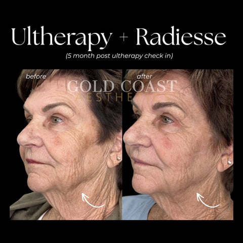 Before and after facial comparison showing skin improvements from Ultherapy and Radiesse treatment at 5 months post-procedure