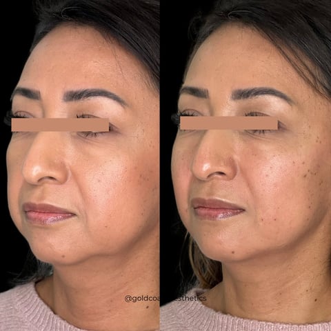 Before and after comparison of facial skin treatment showing reduced acne and improved skin texture on a womans face