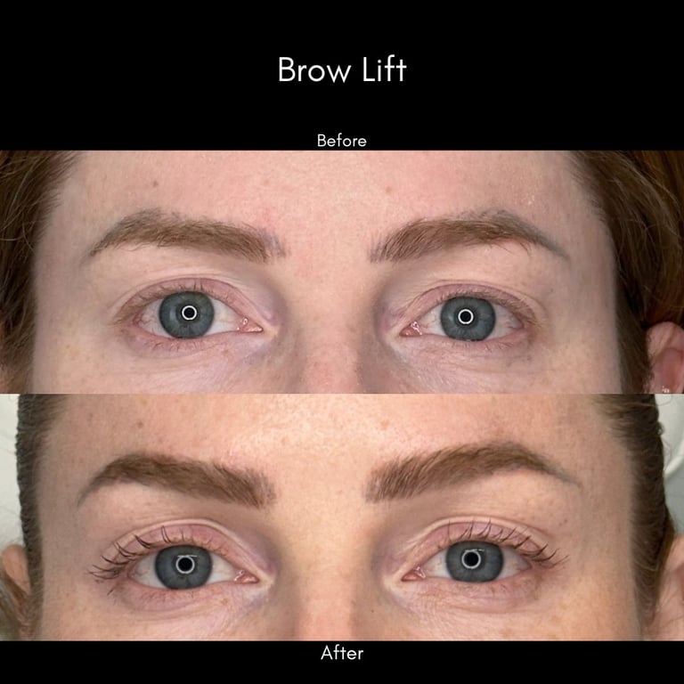 Before and after brow lift comparison showing lifted eyebrows with enhanced definition and more open eye appearance