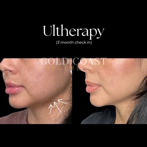 Before and after Ultherapy treatment at 3 month check-in showing skin tightening results on jawline and chin area