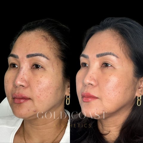 Before and after comparison of facial skin treatment showing reduced redness and improved complexion on the right side