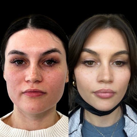 Before and after facial comparison showing a woman with reduced redness and improved skin clarity on the right side