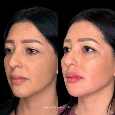 Before and after comparison of facial enhancement treatment showing improved skin texture and lip volume