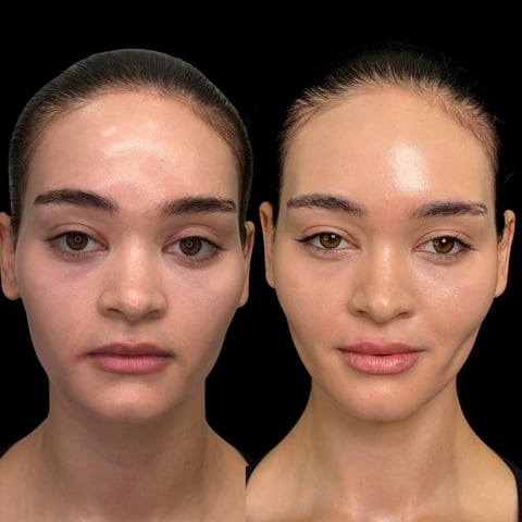 Before and after comparison of facial skin treatment showing reduced redness and improved complexion on the right side