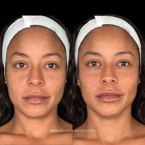 Before and after comparison of facial aesthetics treatment showing skin texture and tone improvements