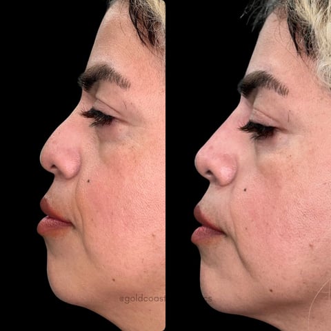 Before and after profile comparison showing facial contouring results with improved jawline and chin definition