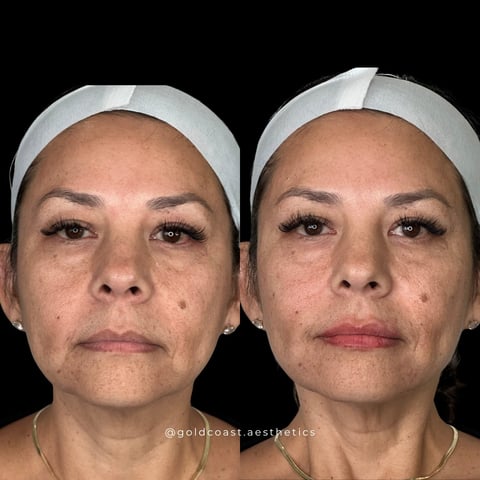 Before and after facial treatment comparison showing womans face with reduced fine lines and improved skin texture on right side