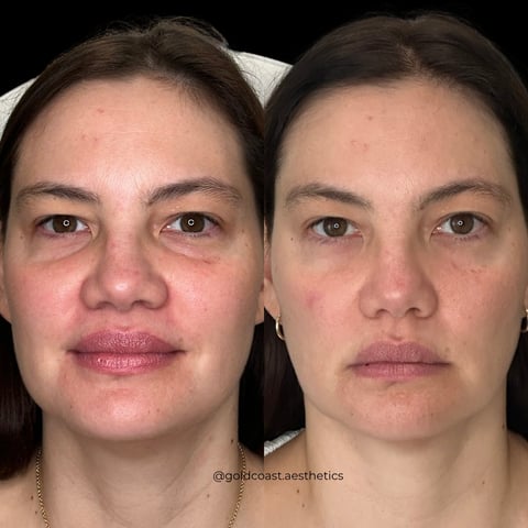 Before and after comparison of facial treatments showing reduced redness and improved skin texture on a womans face