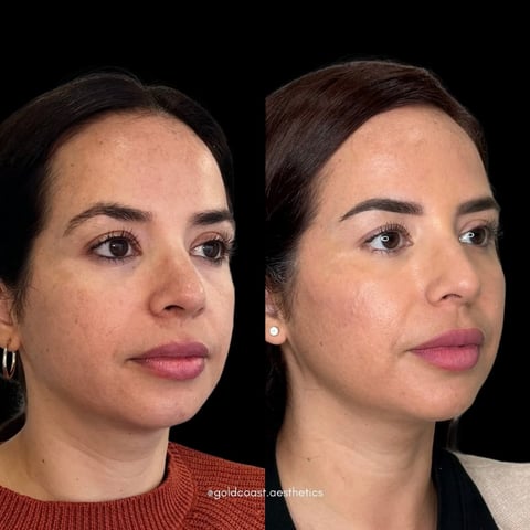 Before and after facial cosmetic treatment comparison showing improved skin texture and definition