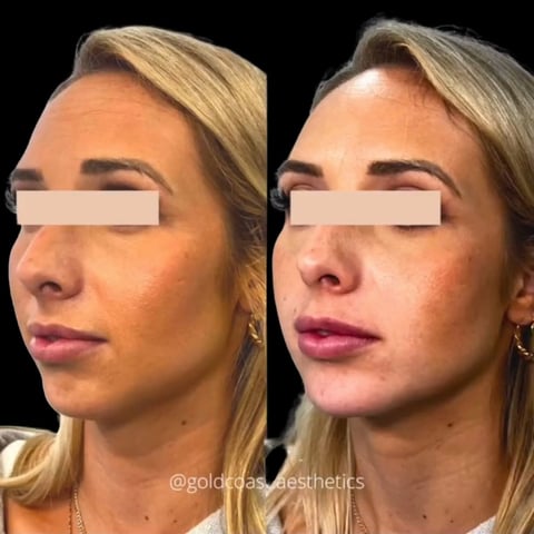 Before and after side profile comparison of facial contouring treatment showing enhanced definition and volume