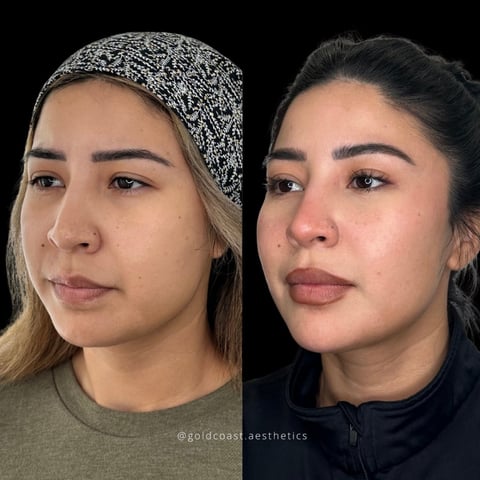 Before and after facial transformation comparison showing same woman with enhanced facial contours and fuller lips