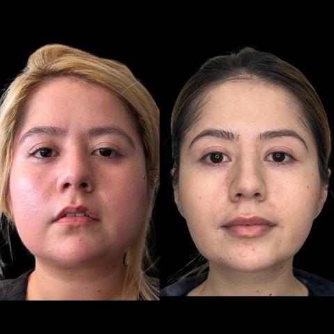 Before and after facial comparison showing two portrait photos of a woman against a black background