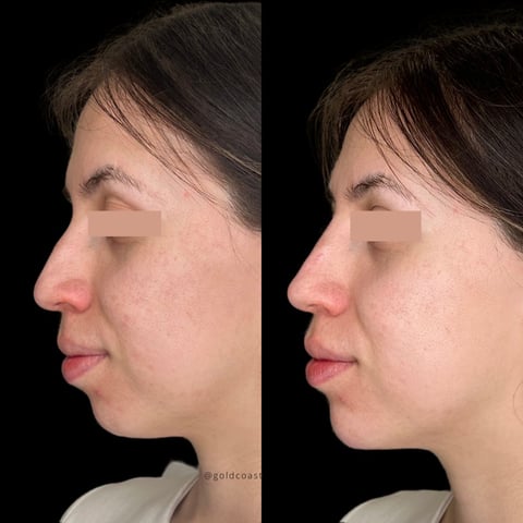 Before and after profile comparison showing facial changes, left image appears more pronounced, right image shows refinement