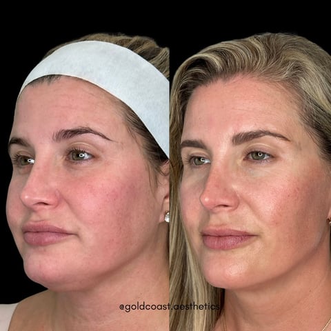 Before and after cosmetic treatment comparison showing womans face from side angle, left with headband and redness, right with improved skin appearance
