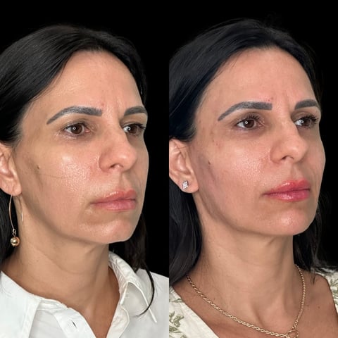 Before and after facial comparison showing results of cosmetic enhancement on a womans face against black background