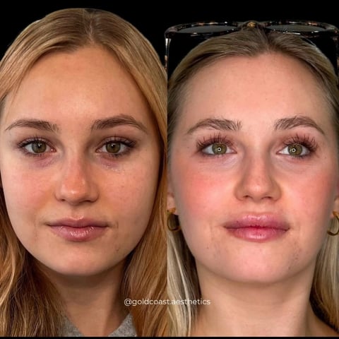 Before and after facial comparison showing cosmetic treatment results with enhanced features and skin appearance